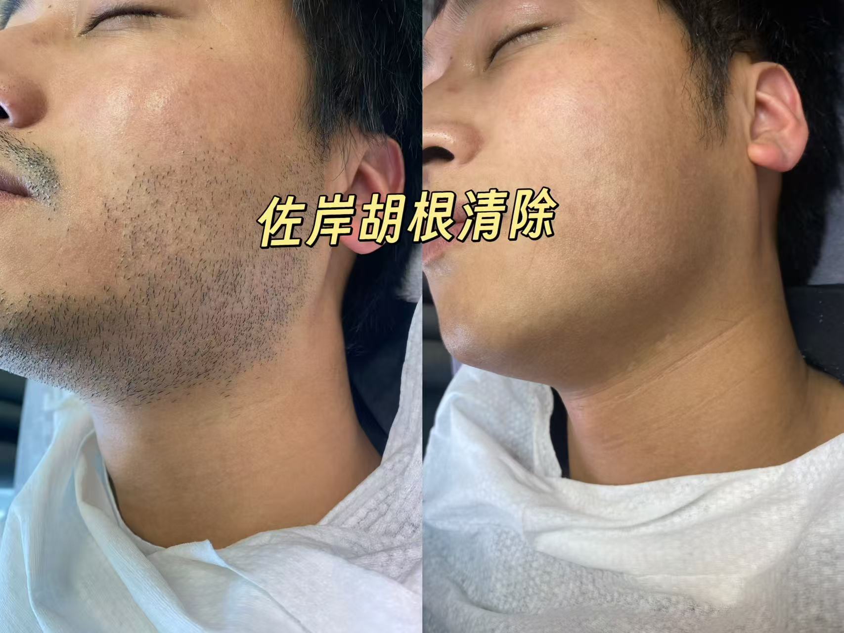 舟山脱胡子